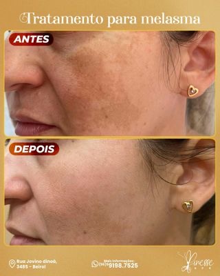 Resultado do procedimento