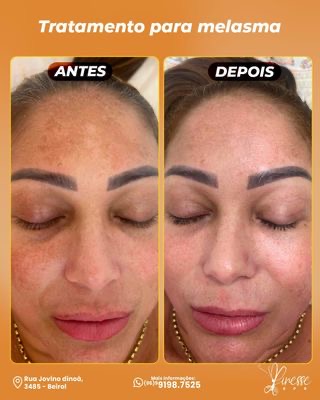 Resultado do procedimento